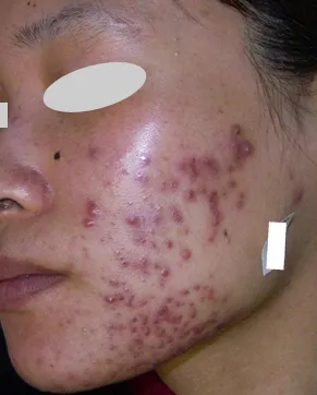 Vビーム治療前（Before）